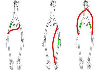 шунтування судин нижніх кінцівок